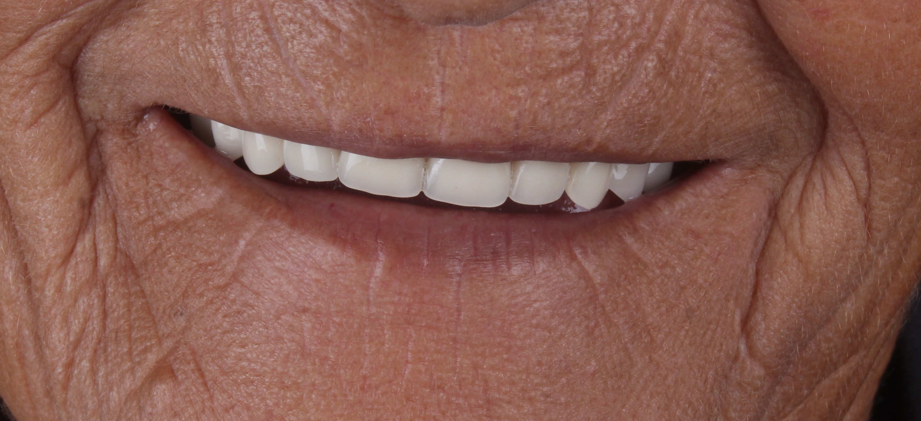 Depois da prótese total